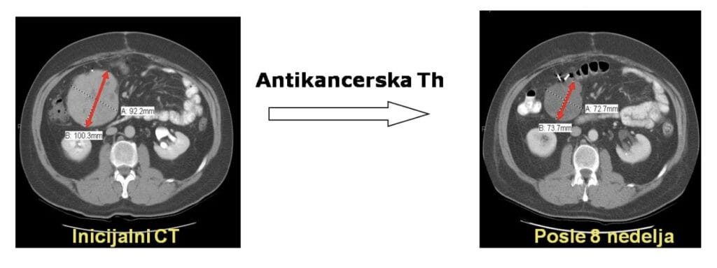antikancerska terapija