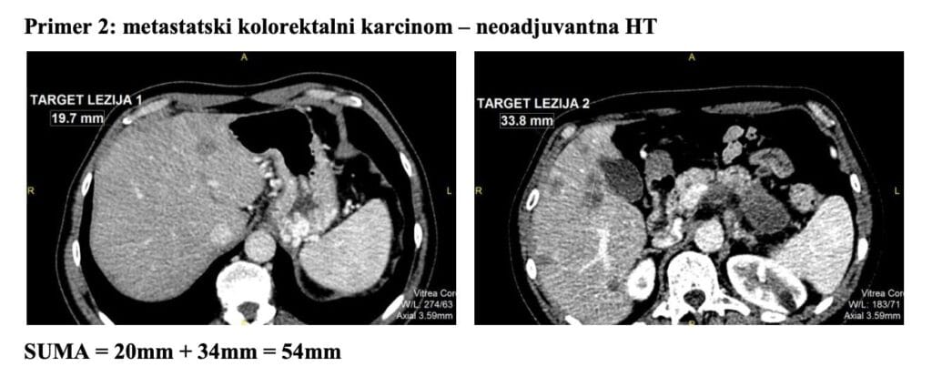 Metastatski kolorektalni karcinom - neoadjuvantna HT