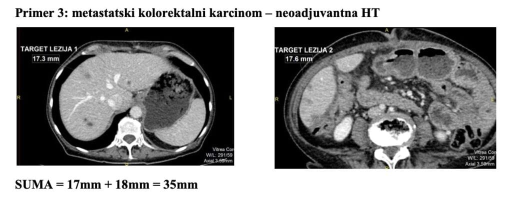 Metastatski kolorektalni karcinom - neoadjuvantna HT