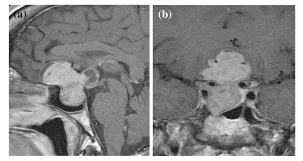 tumor makroadenoma pituitarne žlezde