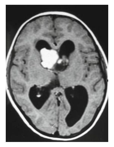 Primarni intraventrikularni tumor