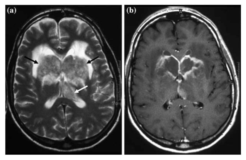 CNS limfom