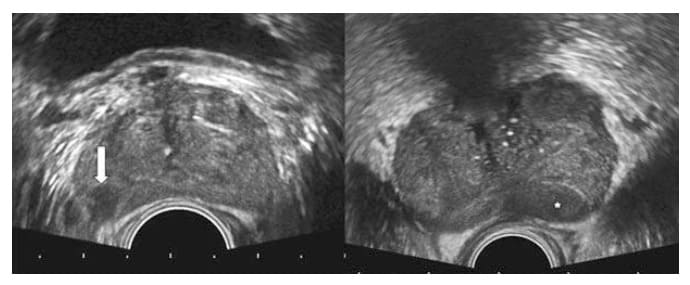 Endorektalni UZ pregled kod pacijenata sa karcinomom prostate