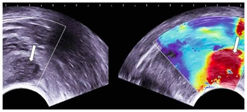 Elastografija kod karcinoma prostate
