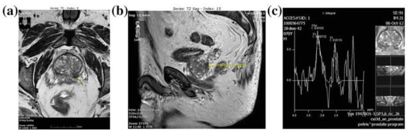 MR spektroskopija prostate