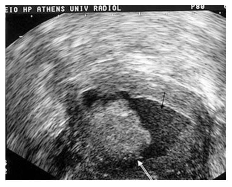 karcinom endometrijuma