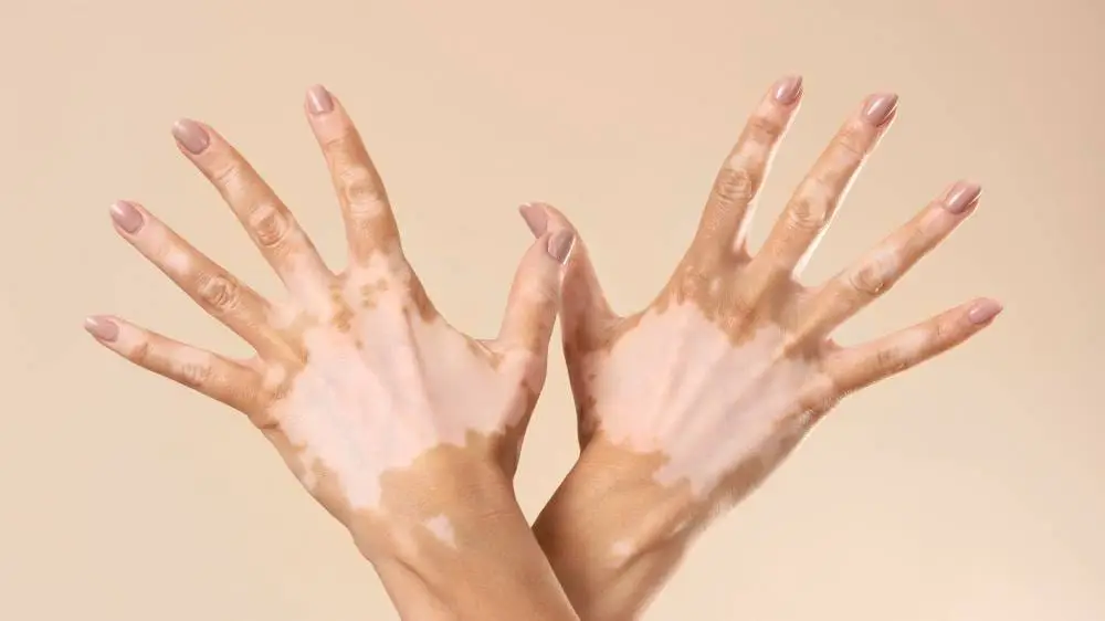 vitiligo slike